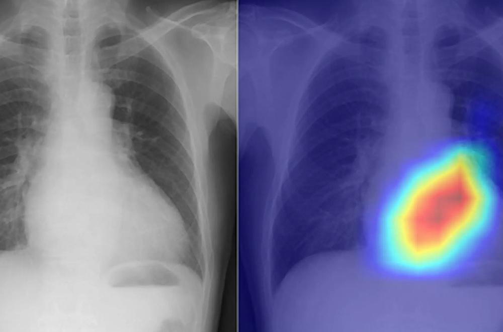 chest-xray-with-ai